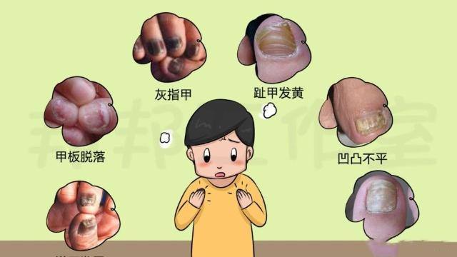      福州灰指甲的早期症状是什么？